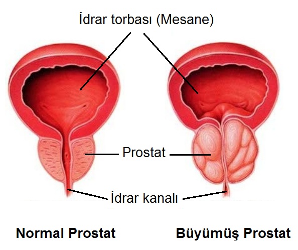 büyümüş prostat